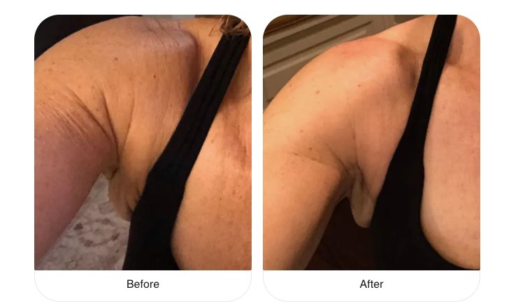 Smooth your crepey skin in time for summer Vitali Skincare Smooth your crepey skin in time for summer Vitali Skincare