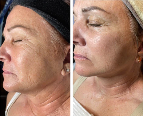 Before and after images showing reduced wrinkles and smoother skin using Vitali's natural anti-aging skincare products.