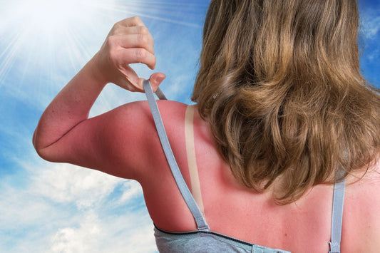 What happens when your skin gets sunburned? - Vitali Skincare